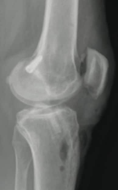 Postoperative radiograph of lateral view